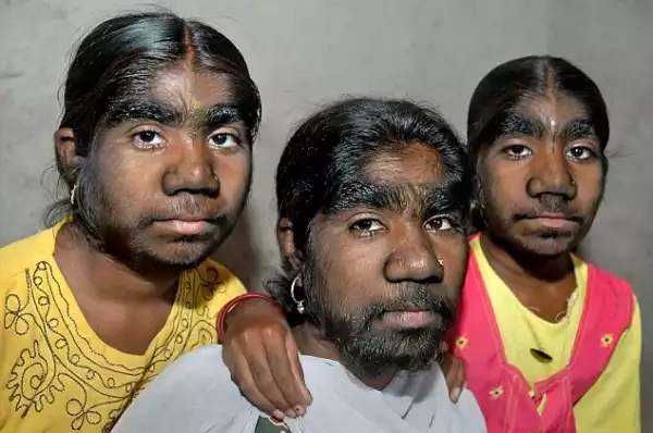 Werewolf Syndrome Affects 3 sisters in one family : WATCH VIDEO